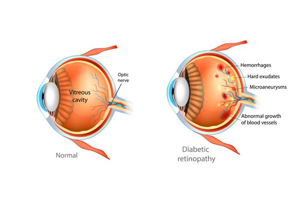 Eye Hospital in Zirakpur