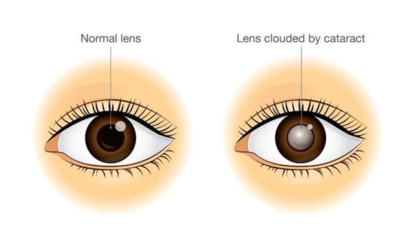 Cataract Surgery in Zirakpur