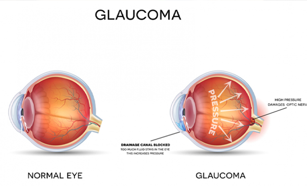 Eye Doctor in Zirakpur